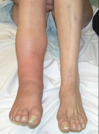 crps pictures