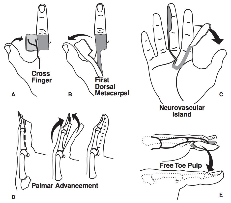 Extremity Flap Reconstruction Hand Orthobullets
