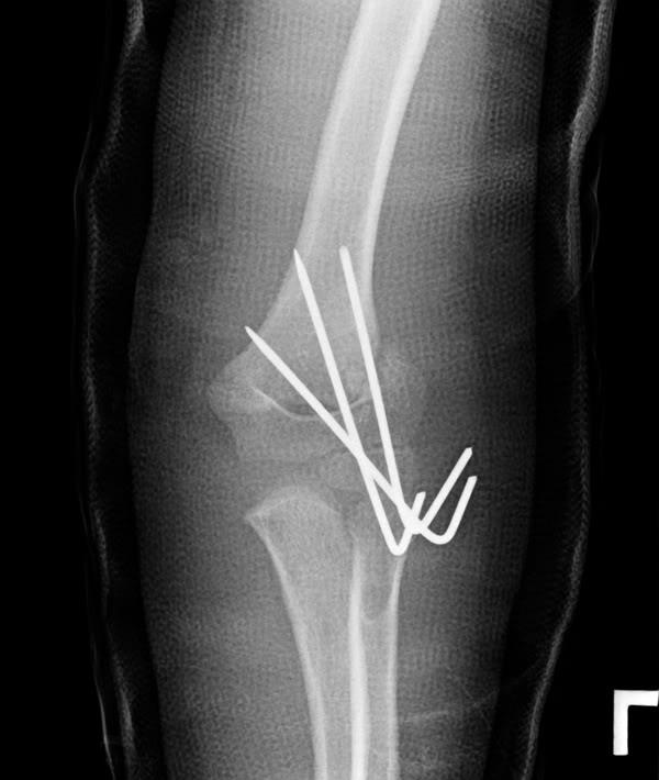 Question 5695 - Qbank - Orthobullets