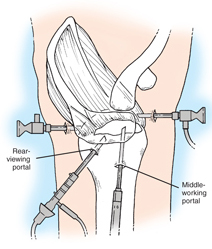 Shoulder Arthroscopy: Indications & Approach - Shoulder & Elbow ...