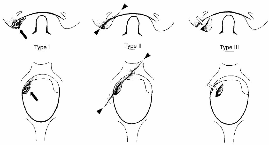 Occipital Condyle Fractures Spine Orthobullets