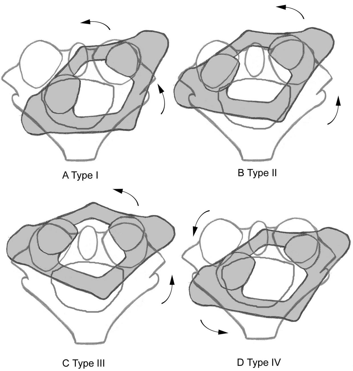 Atlantoaxial Instability Treatment Atlantoaxial Instability Treatment