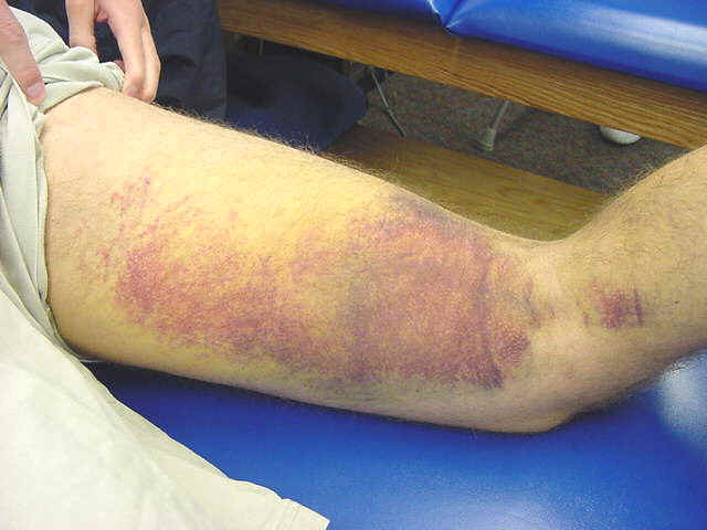 https://upload.orthobullets.com/topic/3102/images/athlet4%5B1%5D_moved.jpg