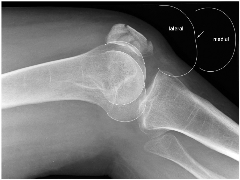 Adult Knee Radiographic Evaluation Recon Orthobullets