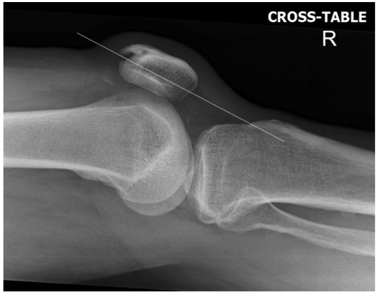 Patella Fracture Trauma Orthobullets Patella Fracture Trauma Orthobullets
