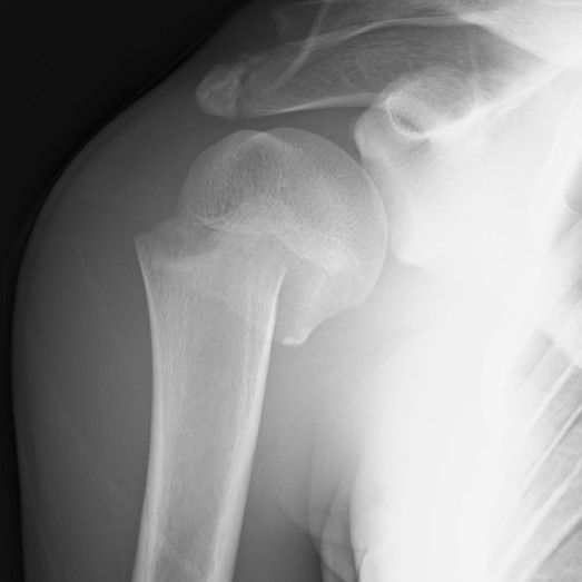 Proximal Humerus Fracture Pediatric Pediatrics Orthobullets