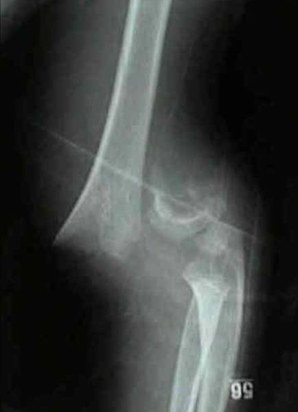 crppf supracondylar fracture