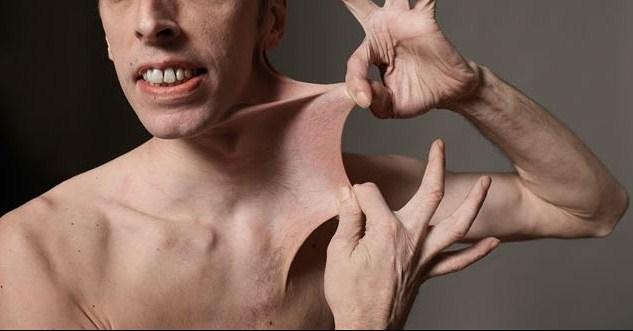 Image result for ehlers danlos syndrome