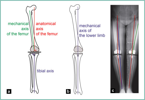 Adult Limb Deformity Correction Recon Orthobullets