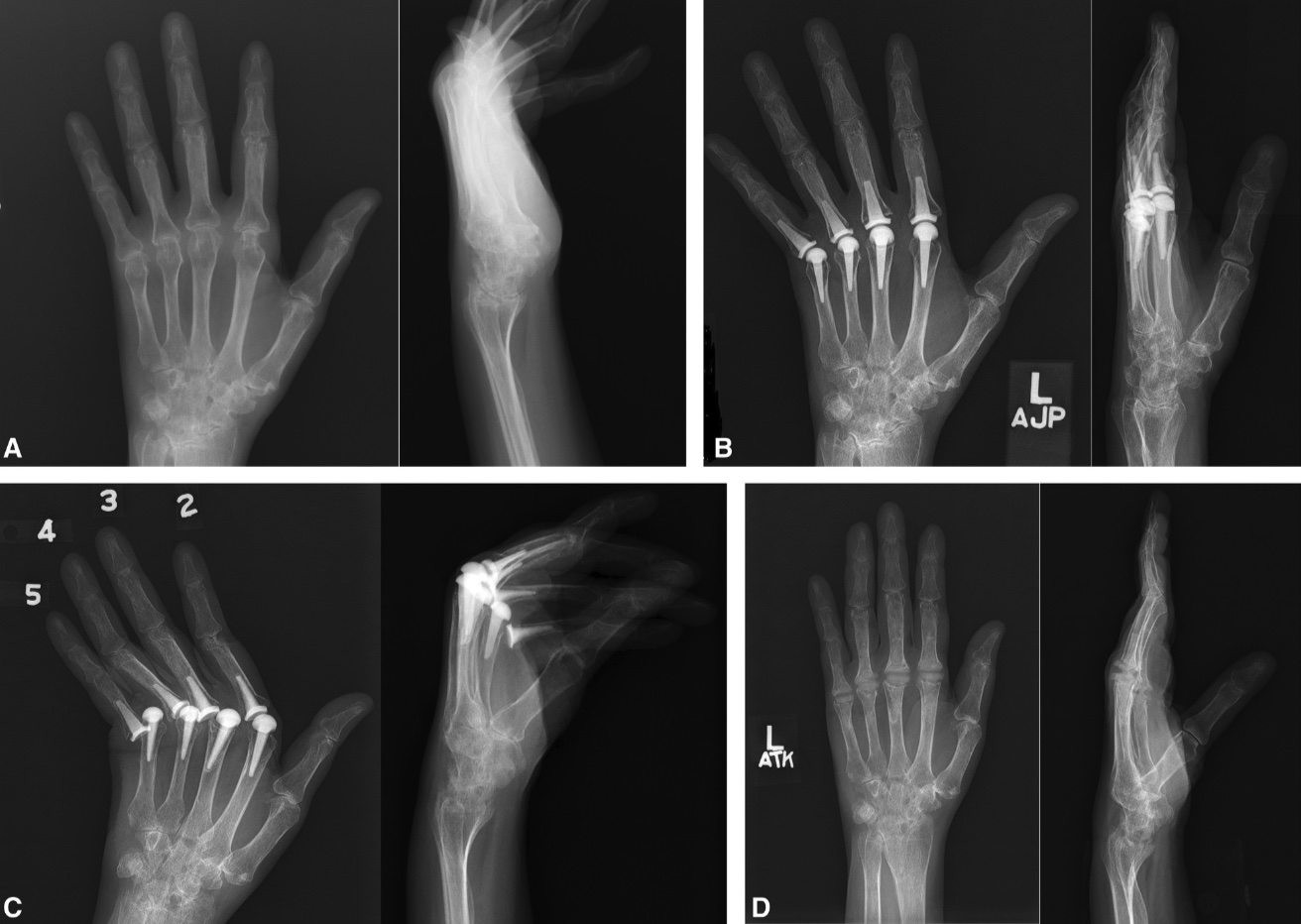 MCP Joint Arthritis Hand Orthobullets