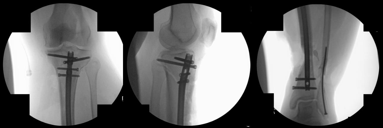 T2 Alpha Tibia Nailing System Implants Orthobullets T2 Alpha Tibia Nailing System Implants Orthobullets