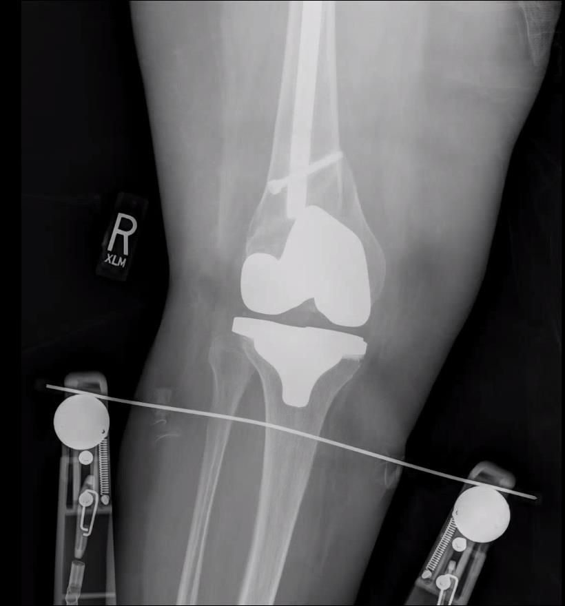 https://upload.orthobullets.com/topic/423242/images/3a77971a-edc9-481b-b655-e8a3a2061bd7_tibial_traction_after_2.jpg