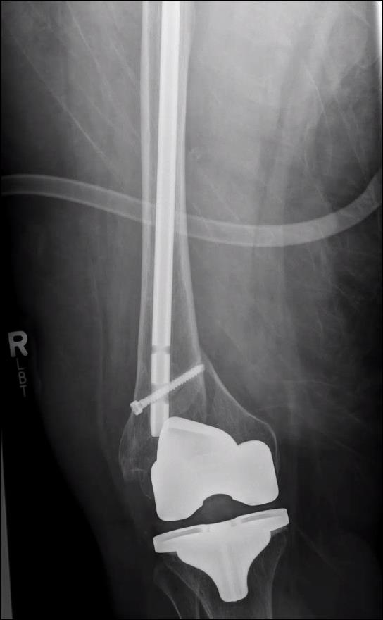 https://upload.orthobullets.com/topic/423242/images/adbec4e6-e34f-4c9d-9f9e-ce626ac18235_tibial_traction_before_2.jpg