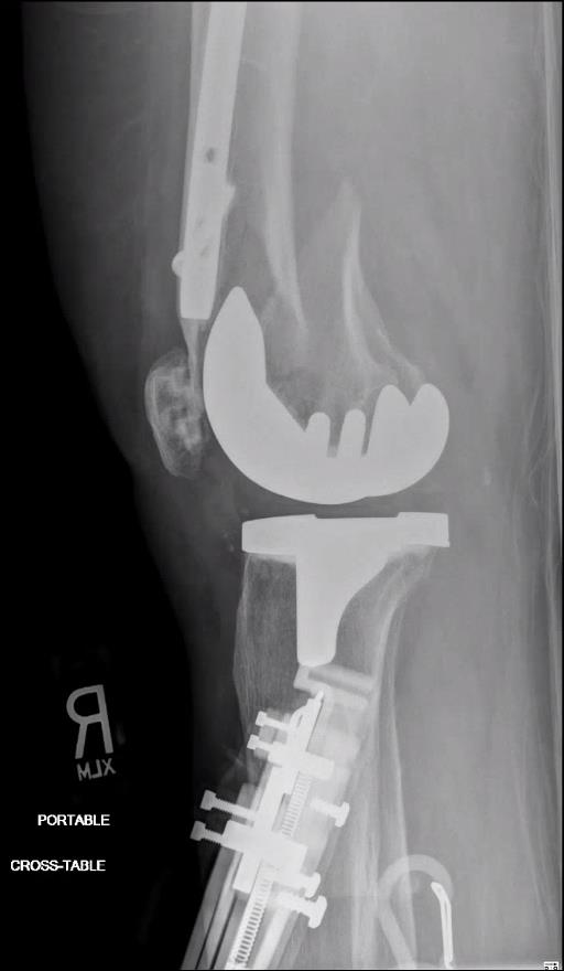 https://upload.orthobullets.com/topic/423242/images/aec82391-6faf-4548-940d-1f594449fbde_tibial_traction_after_1.jpg