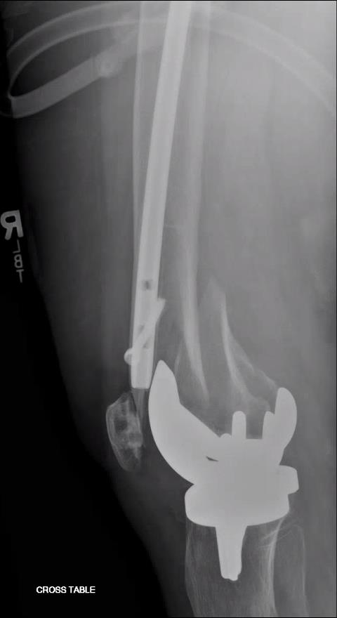 https://upload.orthobullets.com/topic/423242/images/bf999df0-60e8-4519-b85b-8f9f0f01268b_tibial_traction_before_1.jpg