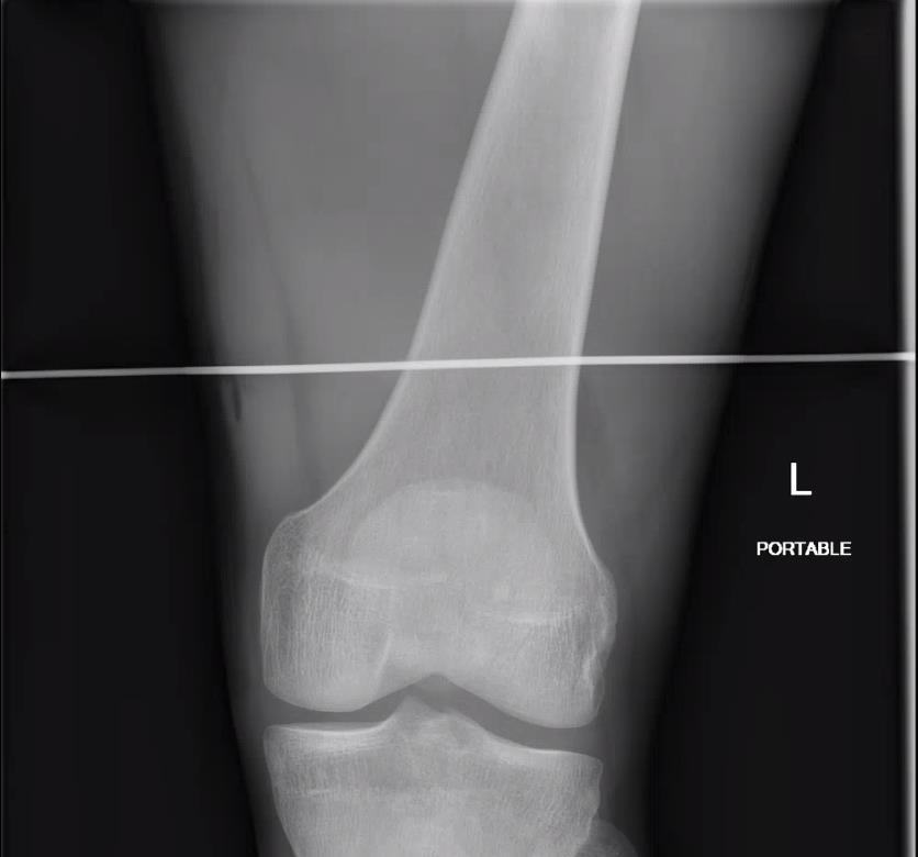 https://upload.orthobullets.com/topic/423245/images/041017e7-27ea-4209-b331-6ef80b46f1c6_femoral_traction_after_2.jpg