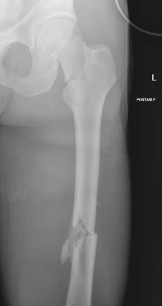 https://upload.orthobullets.com/topic/423245/images/77867119-7f52-4696-b552-81de84dfa6d9_femoral_traction_after_1.jpg