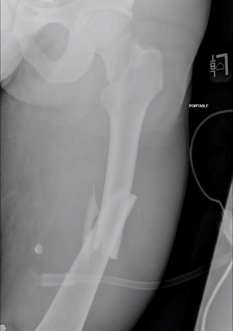 https://upload.orthobullets.com/topic/423245/images/eebf2852-ebb7-4acb-bb33-3d928376a3ff_femoral_traction_before.jpg