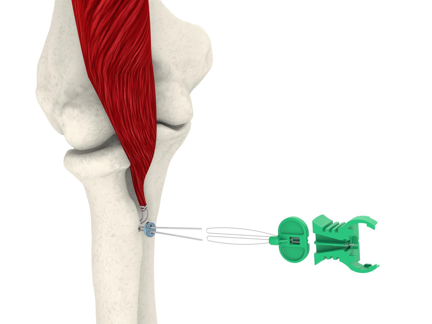 https://upload.orthobullets.com/topic/423246/images/43814171-b847-4a8a-9740-5d7f3412726e_distal_biceps_model_single_button_suture_and_whipstitch.12_copy.jpg