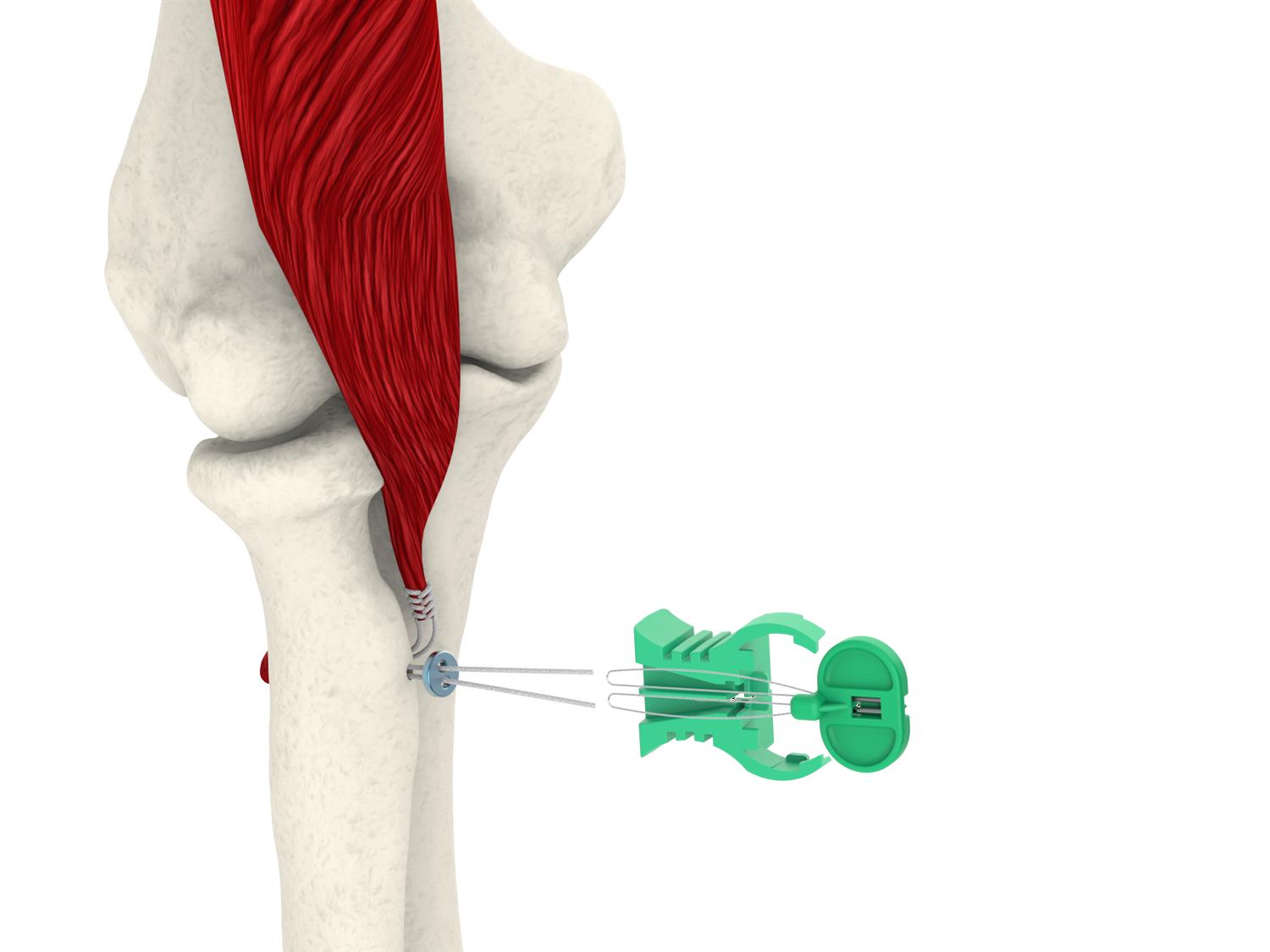 https://upload.orthobullets.com/topic/423246/images/6c451db0-fbc2-46d8-8987-02621af0b6c7_distal-biceps-model-single-button_suture_and_whipstitch.12_copy.jpg
