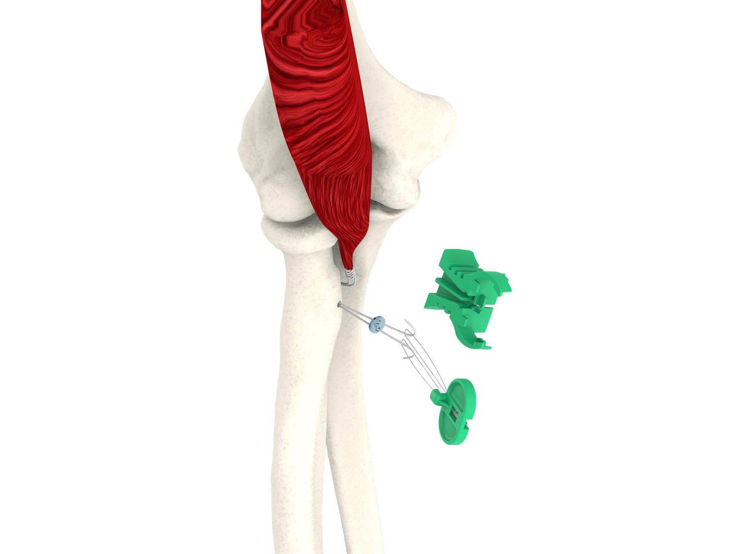 https://upload.orthobullets.com/topic/423246/images/c18d04c7-795e-460f-96cf-1267f71fc4f6_distal_biceps_model_single_button_suture_and_whipstitch.84_copy.jpg