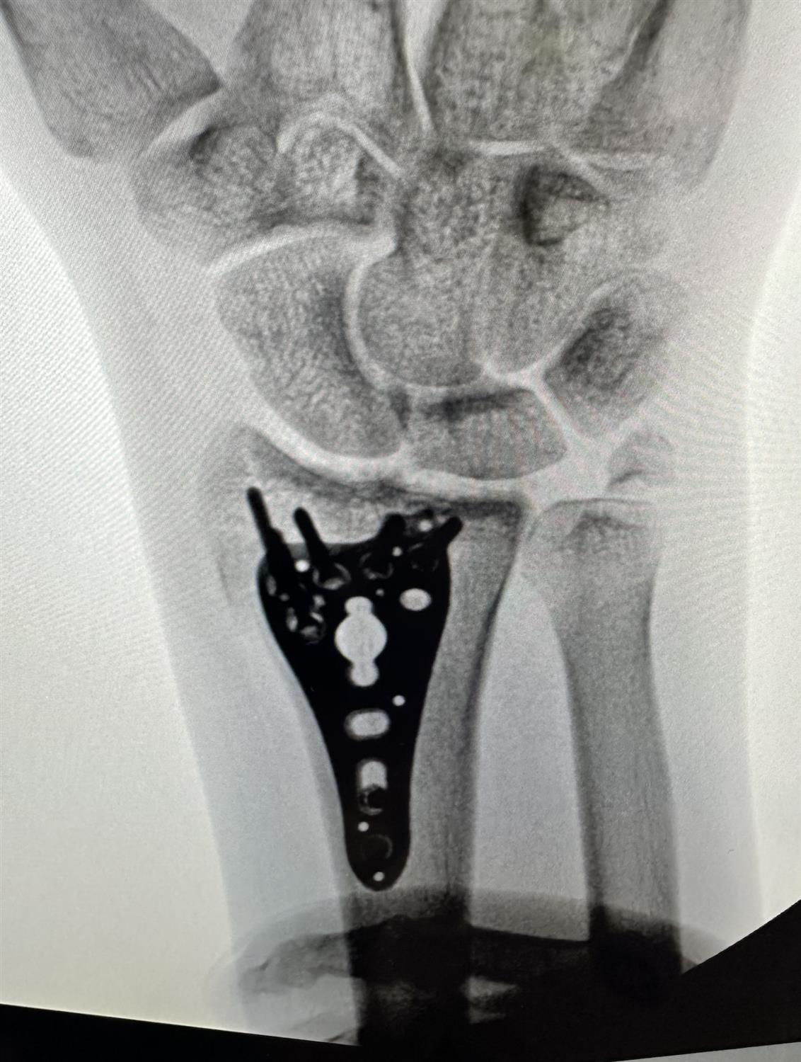 https://upload.orthobullets.com/topic/423257/images/ec69327d-9e71-49ca-89dd-0fc8b3e58708_screenshot_2025-04-11_at_9.27.00_am.jpg