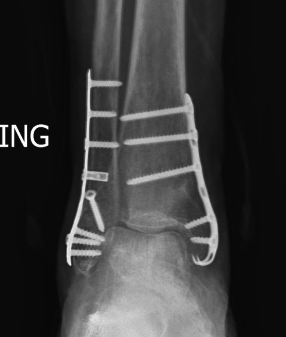 https://upload.orthobullets.com/topic/423259/images/103be1ae-0807-46b9-b4c4-24513fef9c4f_afx_plates_hook_and_lat_plates.jpg