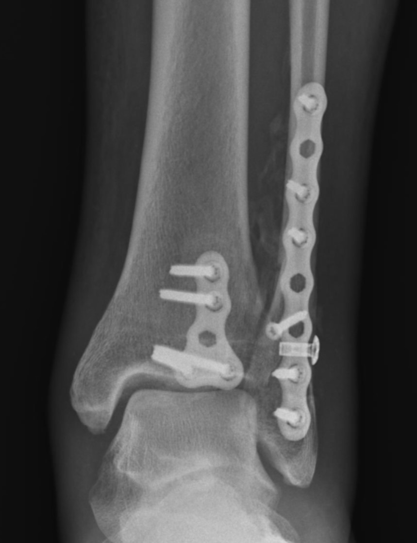 https://upload.orthobullets.com/topic/423259/images/8218da3b-8bea-4024-9556-50715972129d_afx_plates_post_dist_tib_postlat_fib.jpg