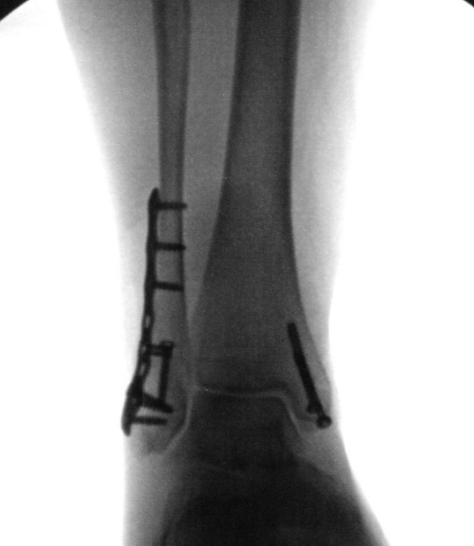 https://upload.orthobullets.com/topic/423259/images/e57afbe2-0897-4812-9662-89631c18e043_afx_plate_anatomic_dist_fib.jpg
