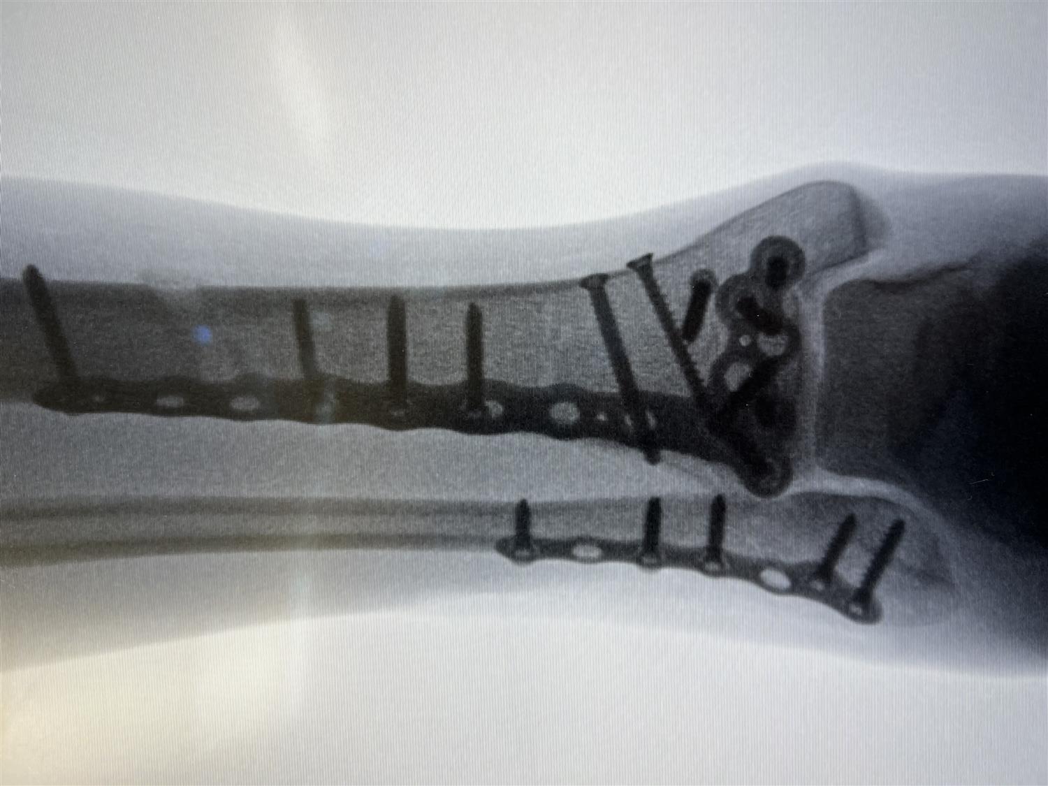 https://upload.orthobullets.com/topic/423261/images/a6d19fb6-1120-409c-bb6a-0f15e0fe4fb7_gorilla_pilon_plate.jpg