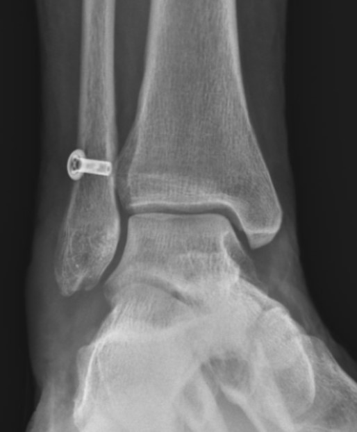 https://upload.orthobullets.com/topic/423263/images/a24701f9-918b-43a3-8ada-858e15be22ab_r3flex_isolated_injury.jpg