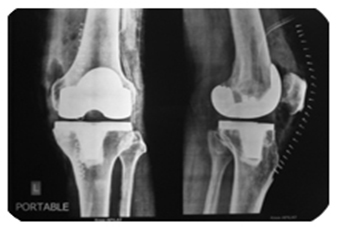 https://upload.orthobullets.com/topic/423291/images/d7785092-e5a9-4e20-9356-56056cb49ab5_persona_knee-_postop-2-large.jpg