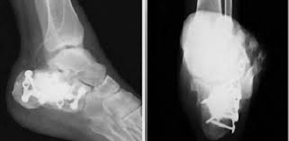 https://upload.orthobullets.com/topic/423299/images/fc10f379-0c49-463d-b85a-24997ea3672e_ankle.jpg