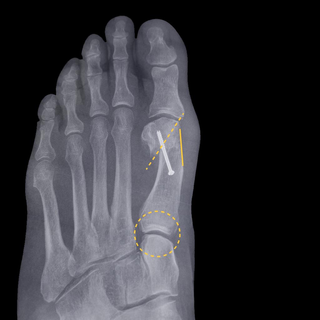 https://upload.orthobullets.com/topic/423304/images/ef54e543-bfe9-432b-abbc-70c14cb91362_2d-bunion-surgery-2-1024x1024_copy.jpg