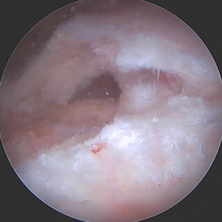 https://upload.orthobullets.com/topic/423312/images/cae00b71-48da-461b-beee-27bc9d3cd812_delamination-of-supraspinatus_q320.jpg
