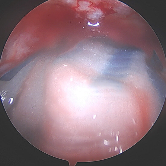 https://upload.orthobullets.com/topic/423312/images/f6f6aa97-1a78-4840-8bf2-e5167ad37df1_tapestry-biointegrative-implant-covering-the-repair.jpg
