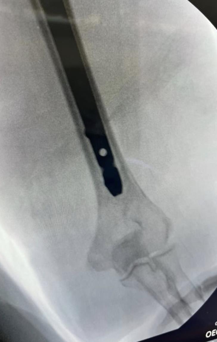 https://upload.orthobullets.com/topic/423321/images/1fe5086a-cdbf-42ca-ac71-18c068b72140_screenshot_2026-05-19_at_2.50.34_pm.jpg