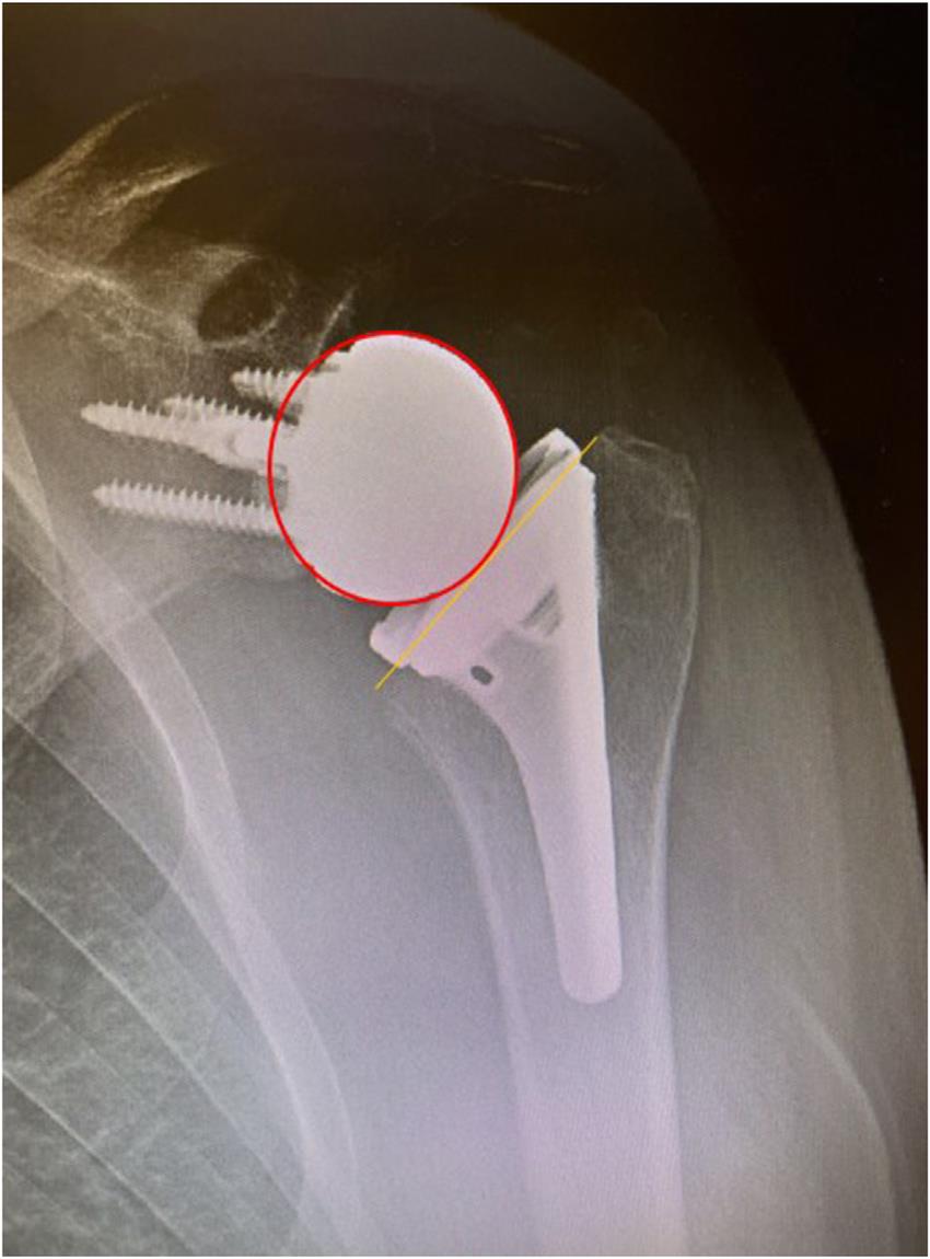 https://upload.orthobullets.com/topic/423349/images/77ca9faf-6592-4217-80bb-614920cebbaf_left-shoulder-ap-x-ray-demonstrating-a-at-the-surface-reverse-total-shoulder-arthroplasty.jpg