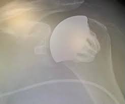 https://upload.orthobullets.com/topic/423349/images/7aacce6c-5798-42a1-908b-156fce20c5a7_images-2.jpg
