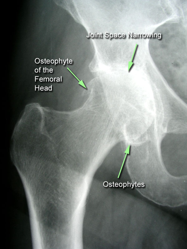Hip Osteoarthritis Recon Orthobullets