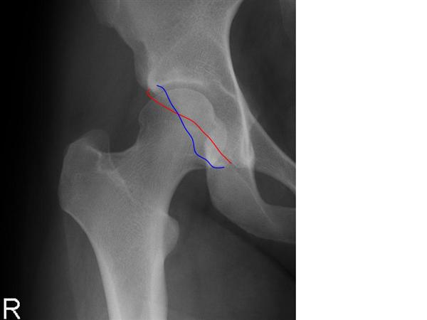 Adult Dysplasia of the Hip : 네이버 블로그
