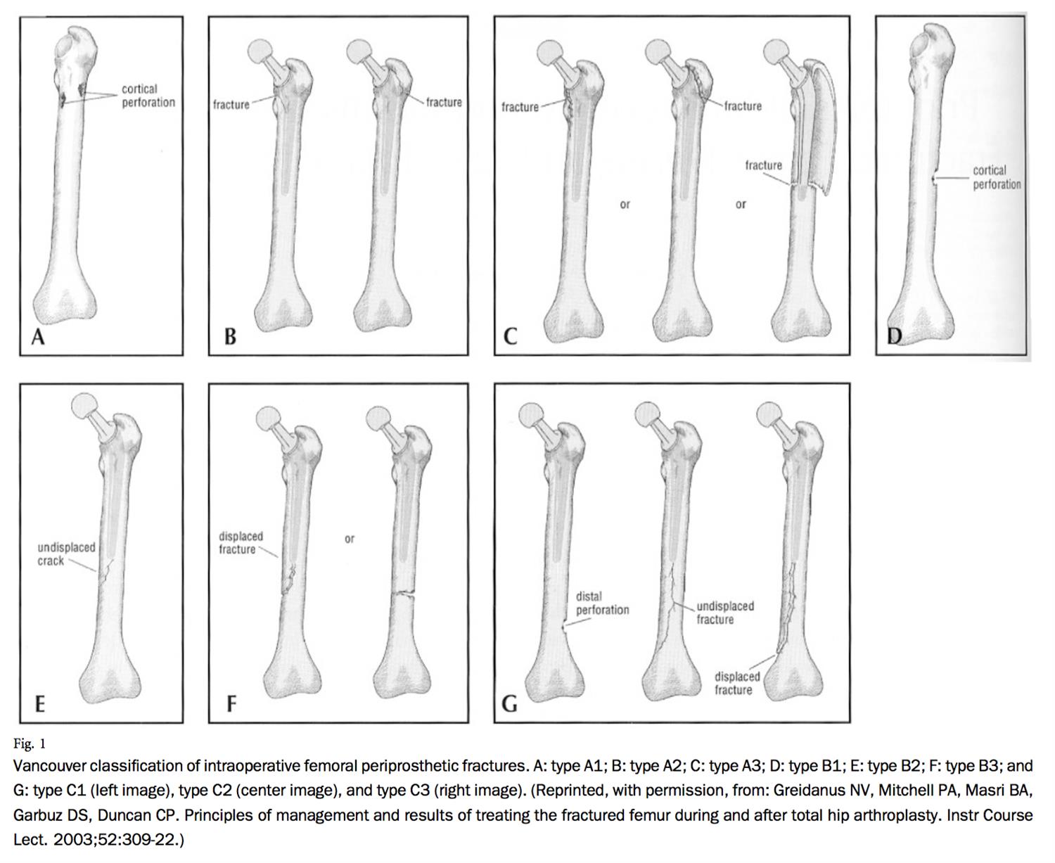 THA Periprosthetic Fracture Recon Orthobullets
