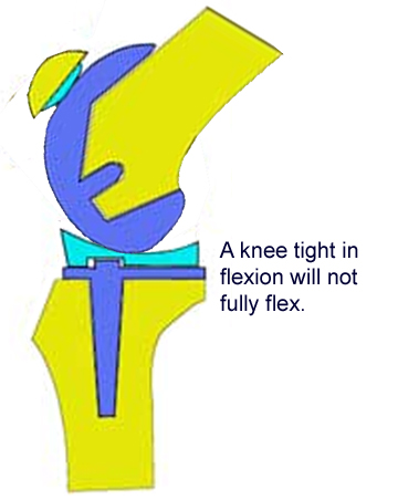 TKA Sagittal Plane Balancing - Recon - Orthobullets
