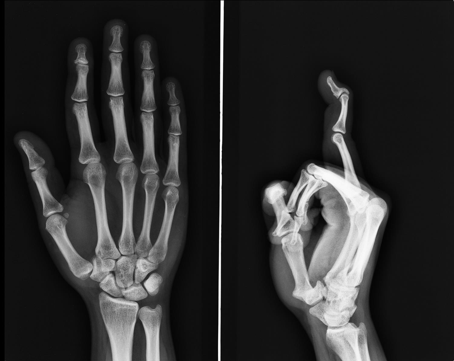 Swan Neck Deformity Hand Orthobullets