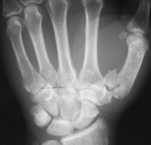 Medical Malpractice Down Under 1 Image result for thumb fracture