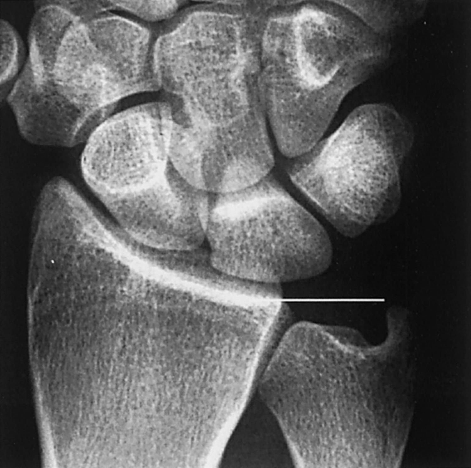 Avulsion Fracture Of Styloid Process Of Ulna