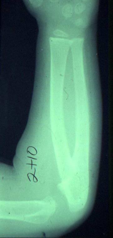 Congenital Radial Ulnar Synostosis - Hand - Orthobullets