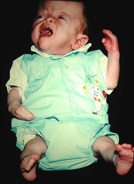 apert syndrome