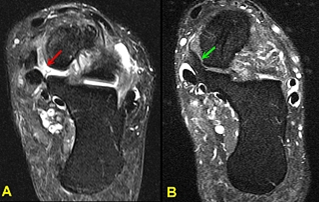 Ankle Ligaments - Foot & Ankle - Orthobullets