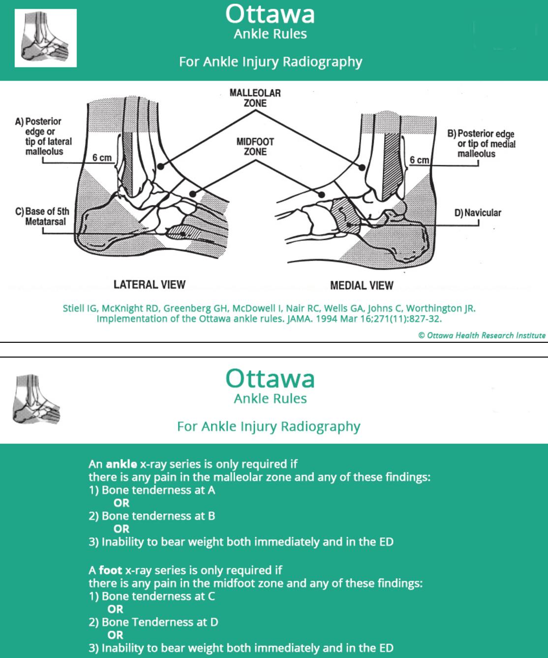 Ankle Sprain Foot Ankle Orthobullets Ankle Sprain Foot Ankle Orthobullets